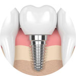 Trồng implant
