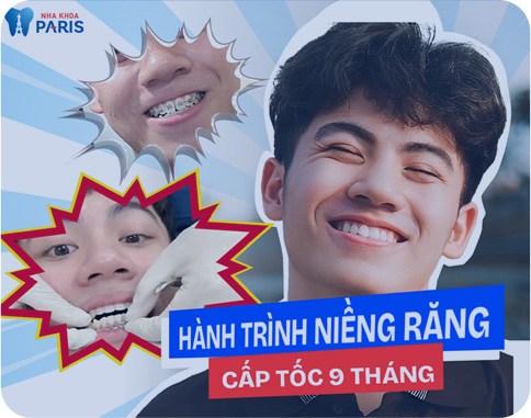 Công nghệ niềng răng rút ngắn 6 tháng